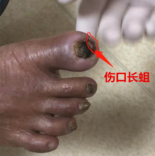 107岁高龄老人右踇趾感染生蛆,和平骨科力排困难解疾患